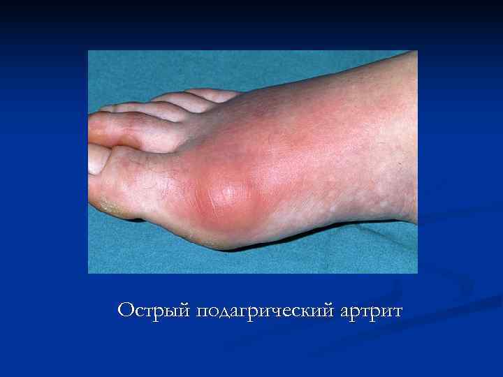 Острый подагрический артрит 