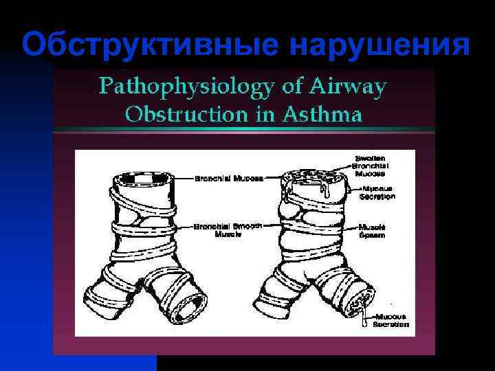Обструктивные нарушения 