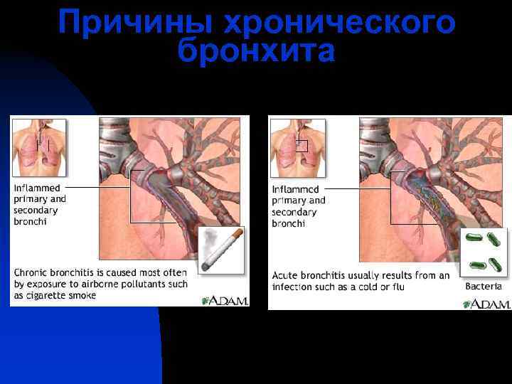 Причины хронического  бронхита 