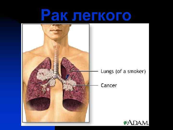 Рак легкого 