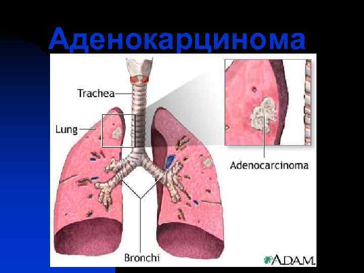 Аденокарцинома 