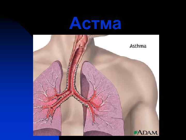 Астма 