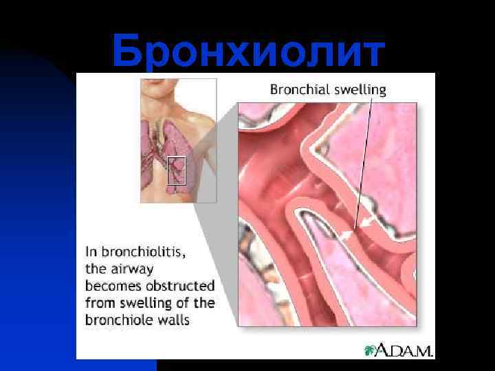 Бронхиолит 