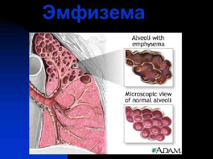 Эмфизема 