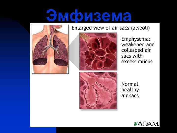 Эмфизема 