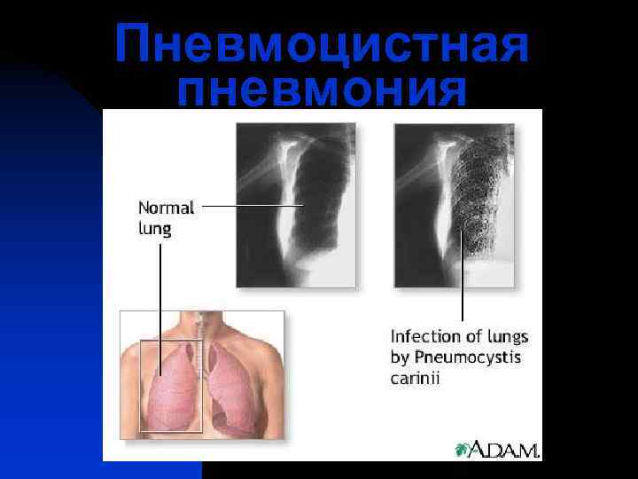 Пневмоцистная  пневмония 