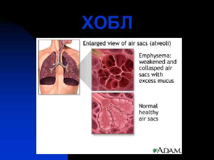 ХОБЛ 