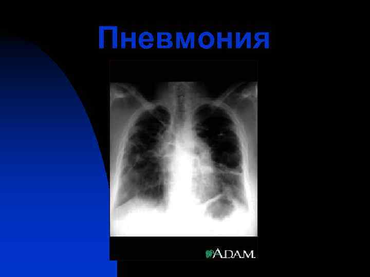 Пневмония 