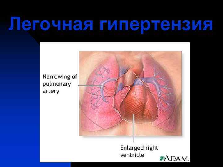 Легочная гипертензия 