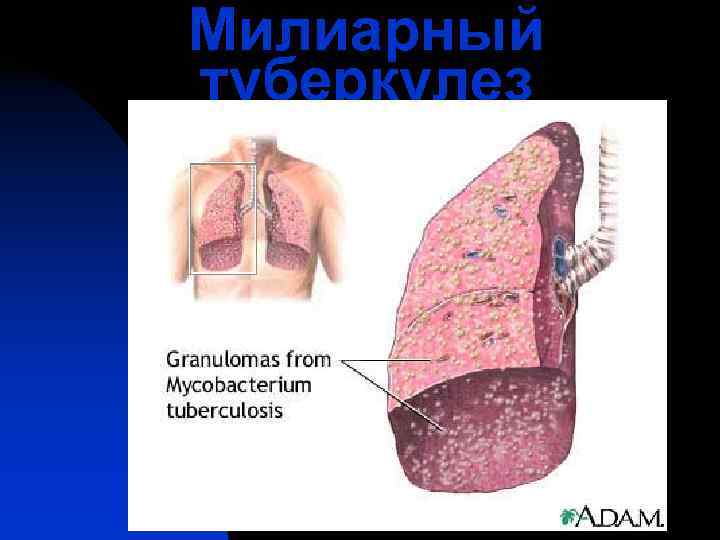 Милиарный туберкулез 