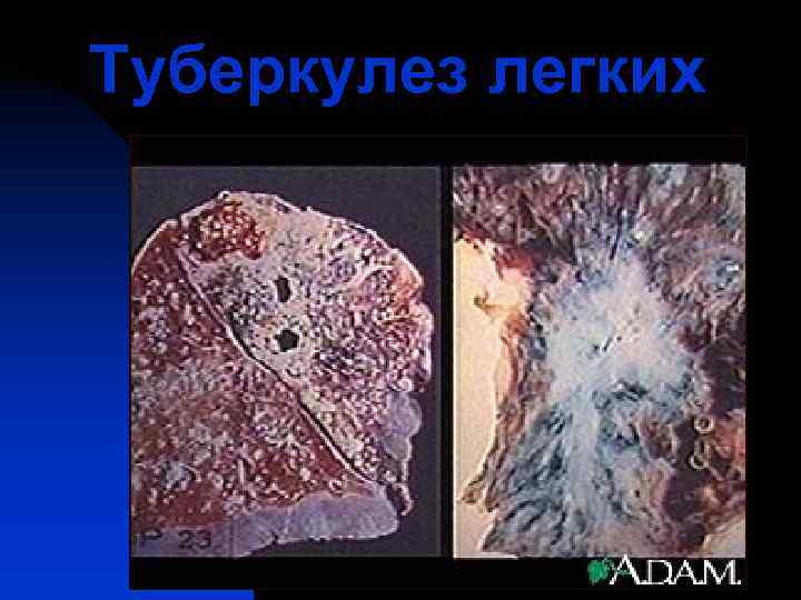 Туберкулез легких 