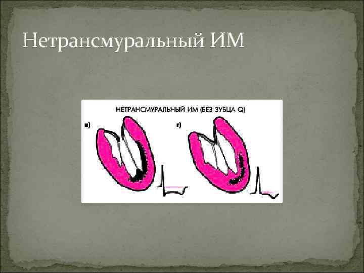 Нетрансмуральный ИМ 