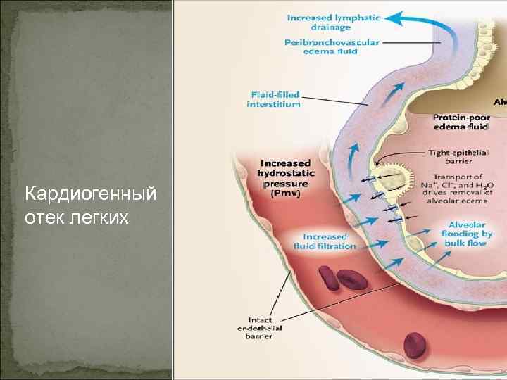Кардиогенный отек легких 