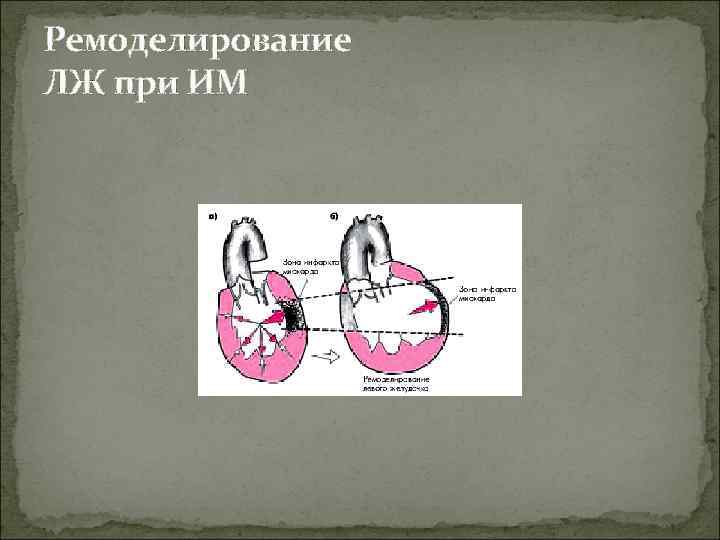 Ремоделирование ЛЖ при ИМ 