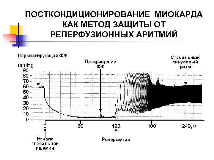 ПОСТКОНДИЦИОНИРОВАНИЕ МИОКАРДА  КАК МЕТОД ЗАЩИТЫ ОТ РЕПЕРФУЗИОННЫХ АРИТМИЙ 