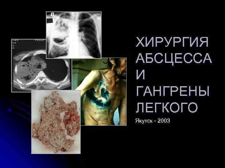 ХИРУРГИЯ АБСЦЕССА И ГАНГРЕНЫ ЛЕГКОГО Якутск - 2003 