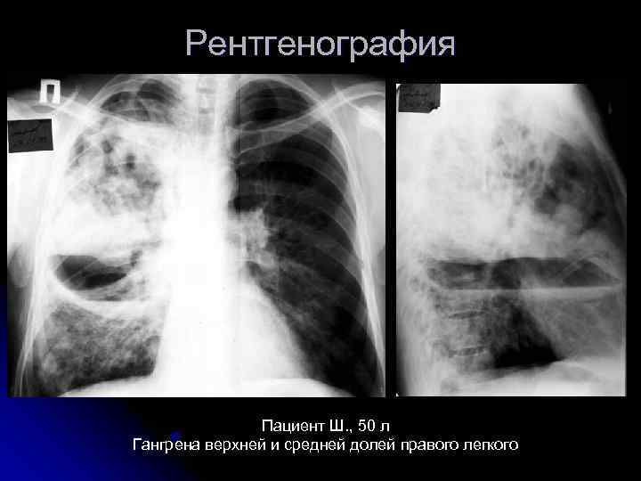  Рентгенография    Пациент Ш. , 50 л Гангрена верхней и средней