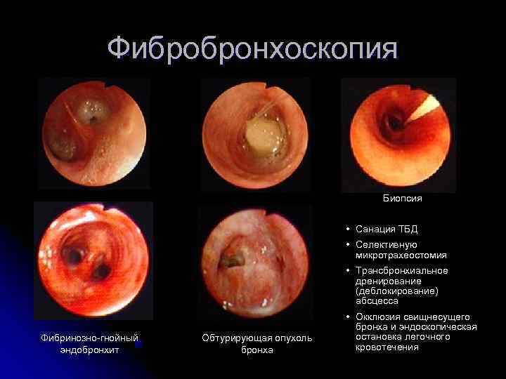   Фибробронхоскопия     Биопсия    • Санация ТБД