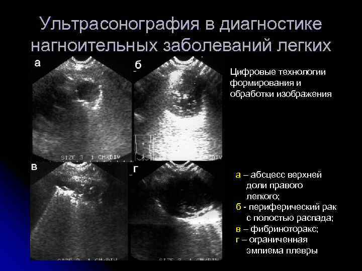  Ультрасонография в диагностике нагноительных заболеваний легких     Цифровые технологии 