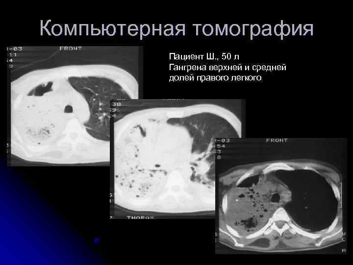 Компьютерная томография  Пациент Ш. , 50 л  Гангрена верхней и средней 