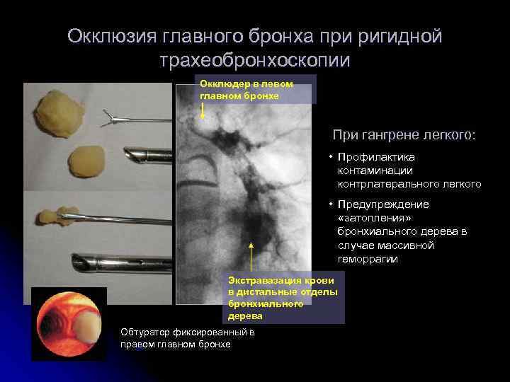 Окклюзия главного бронха при ригидной   трахеобронхоскопии    Окклюдер в левом