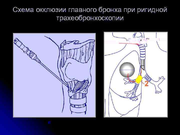 Схема окклюзии главного бронха при ригидной  трахеобронхоскопии 