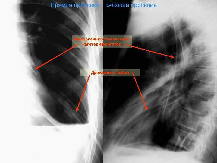 Прямая проекция  Боковая проекция  Микроконикостомический  катетер-ирригатор   Дренажная трубка 