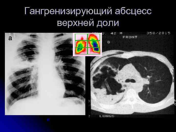 Гангренизирующий абсцесс  верхней доли 