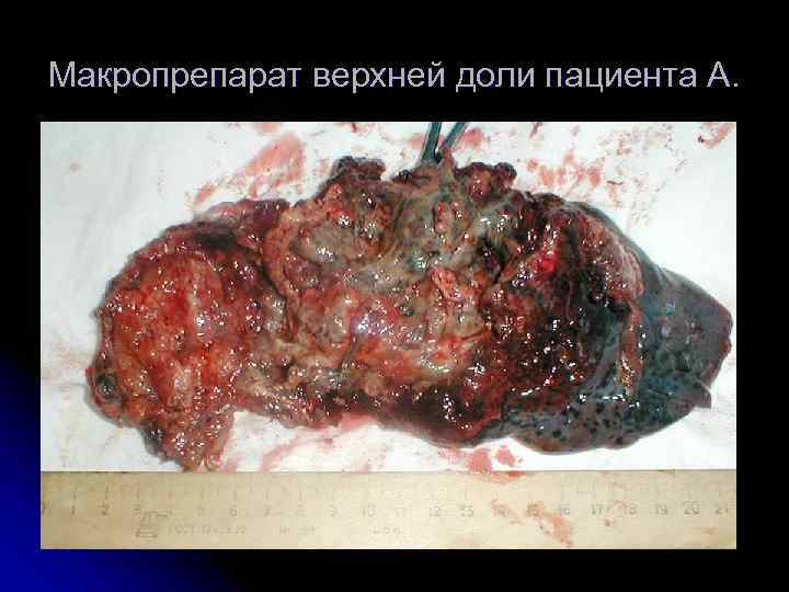 Макропрепарат верхней доли пациента А. 