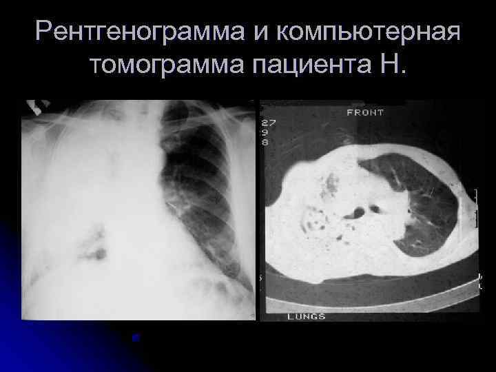 Рентгенограмма и компьютерная  томограмма пациента Н. 