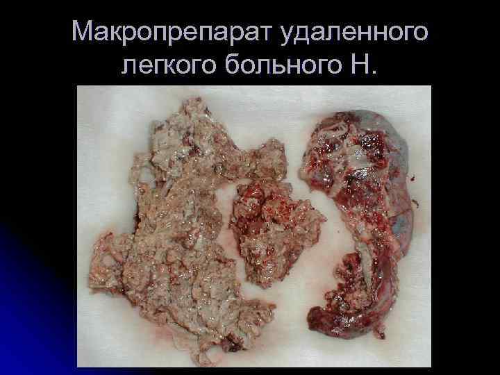 Макропрепарат удаленного  легкого больного Н. 