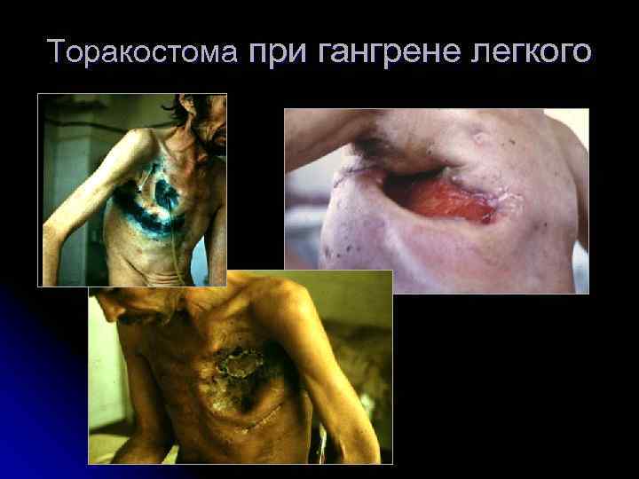 Торакостома при гангрене легкого 