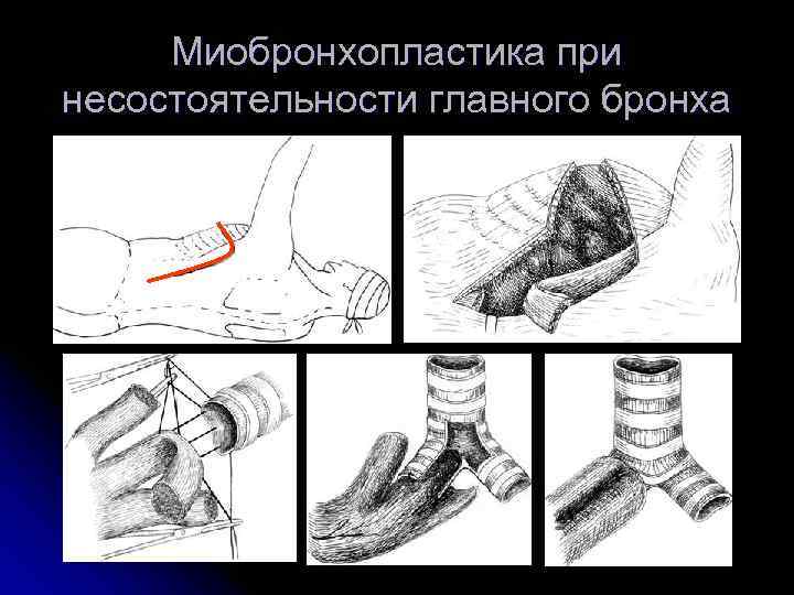  Миобронхопластика при несостоятельности главного бронха 