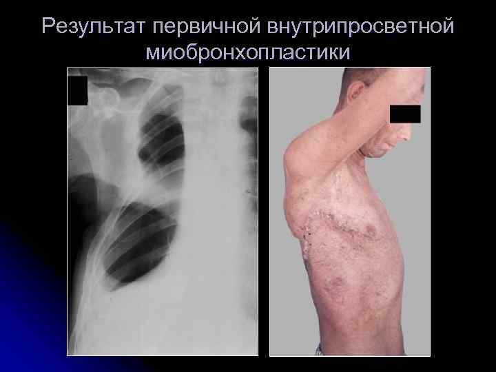 Результат первичной внутрипросветной   миобронхопластики 