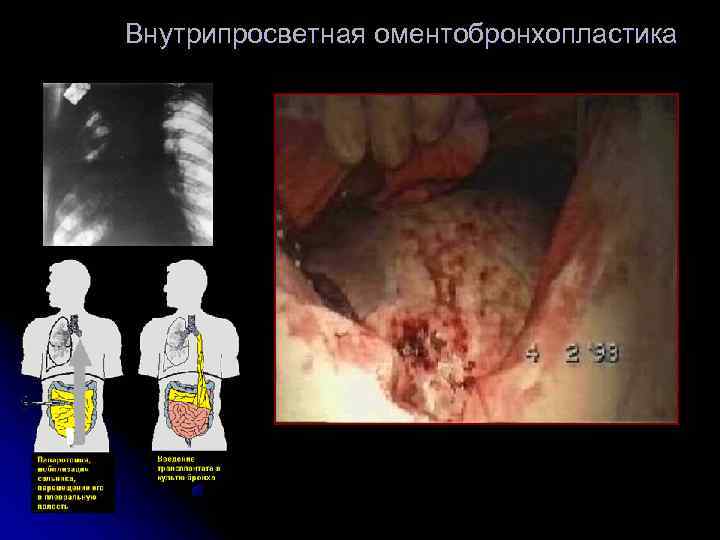 Внутрипросветная оментобронхопластика 