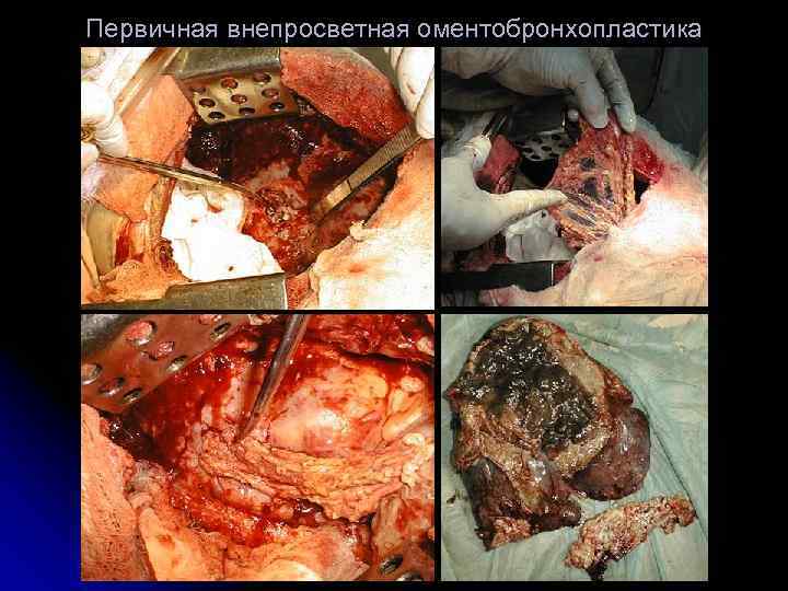 Первичная внепросветная оментобронхопластика 