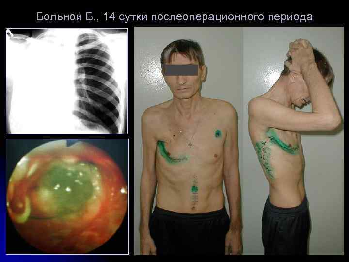 Больной Б. , 14 сутки послеоперационного периода 