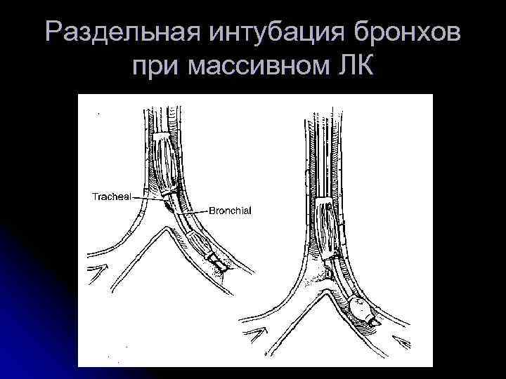Раздельная интубация бронхов  при массивном ЛК 
