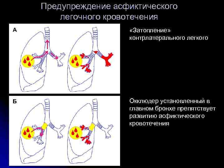   Предупреждение асфиктического   легочного кровотечения А     «Затопление»