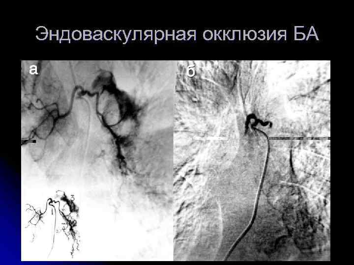 Эндоваскулярная окклюзия БА 