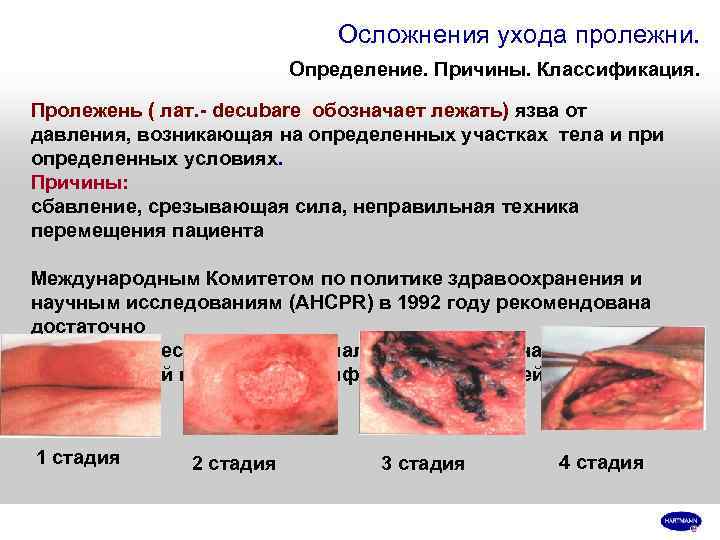      Осложнения ухода пролежни.      Определение.