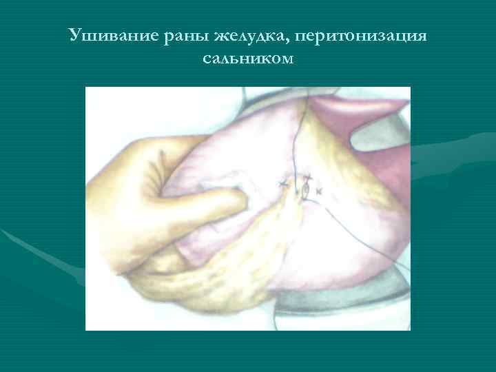 Ушивание раны желудка, перитонизация сальником Ушивание раны желудка, перитонизация сальником