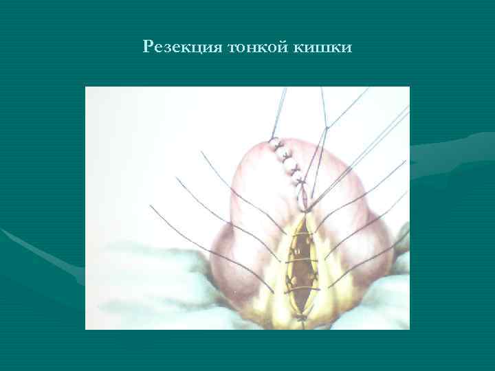 Резекция тонкой кишки Резекция тонкой кишки