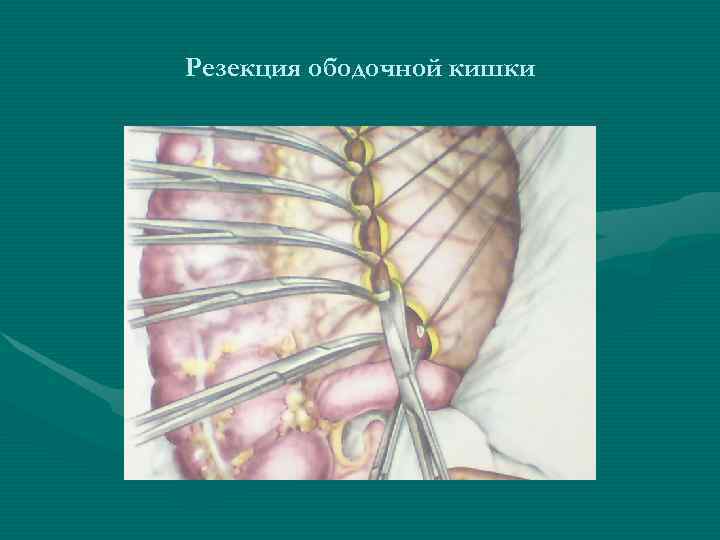 Резекция ободочной кишки Резекция ободочной кишки
