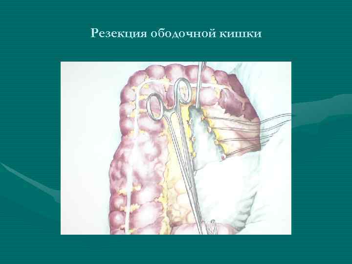 Резекция ободочной кишки Резекция ободочной кишки
