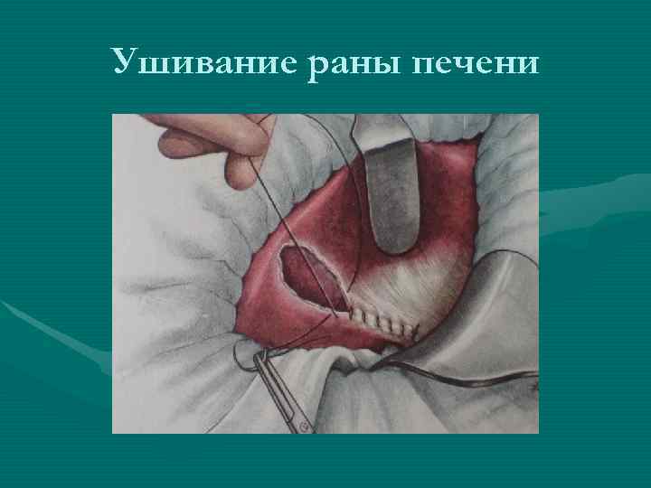 Ушивание раны печени Ушивание раны печени