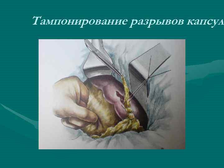 Тампонирование разрывов капсулы Тампонирование разрывов капсулы