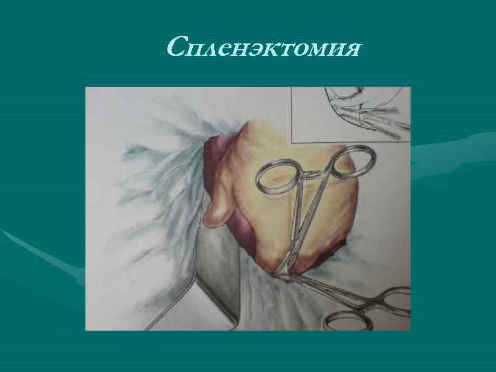 Спленэктомия Спленэктомия
