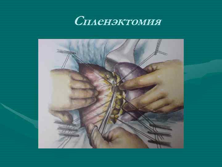 Спленэктомия Спленэктомия