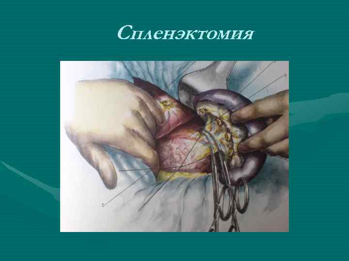Спленэктомия Спленэктомия